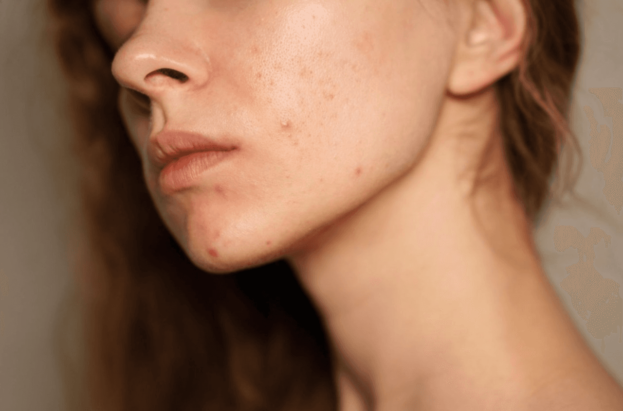 Acne