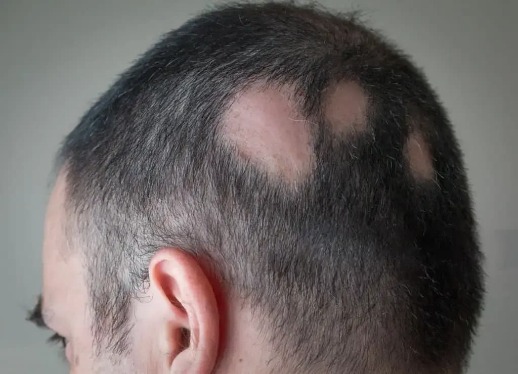 Alopecia  Areata