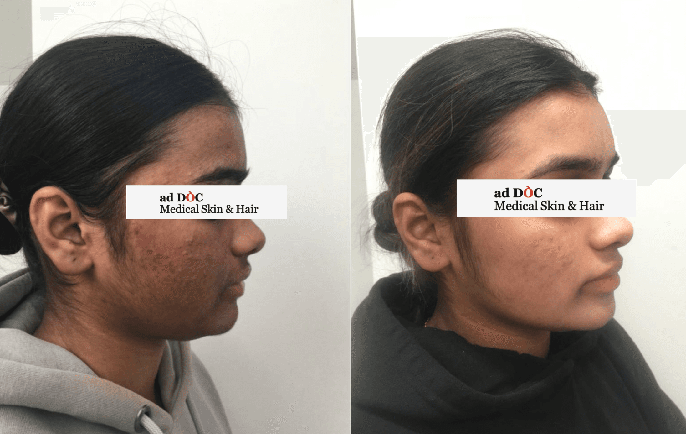 UNIQUE PEEL FORMULA DESIGNED EXCLUSIVELY FOR THE BODY