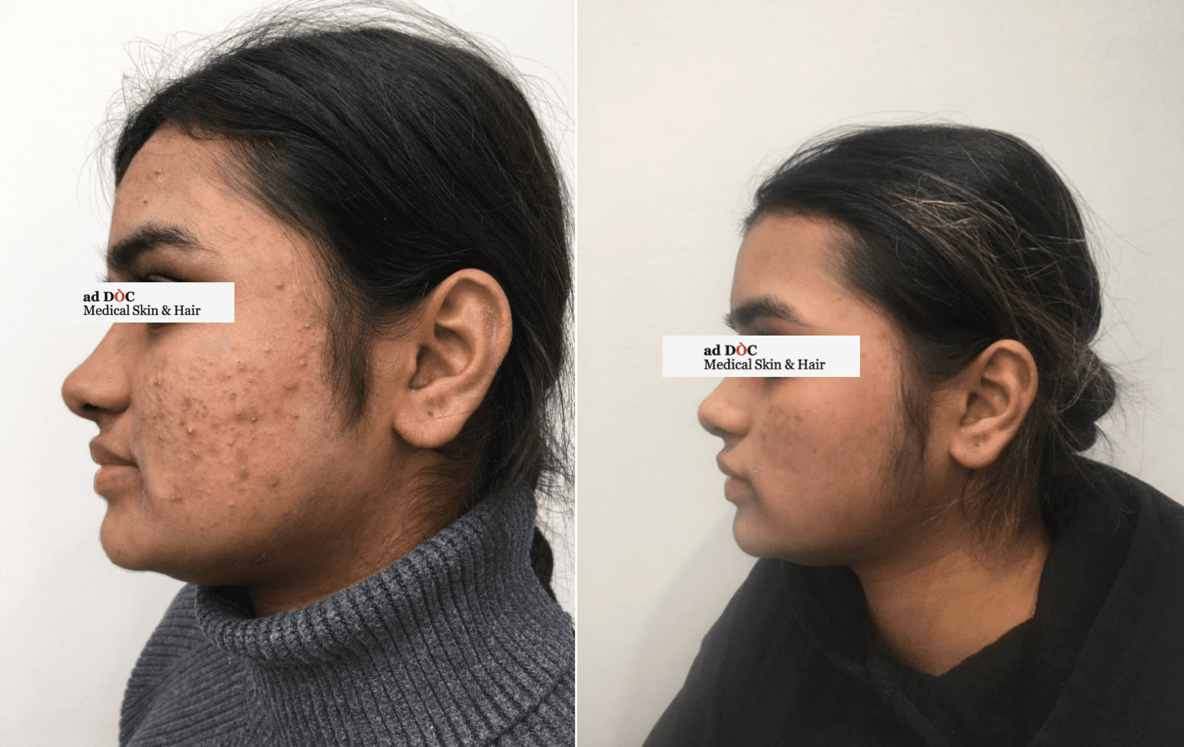 Skin Discoloration & Hyperpigmentation