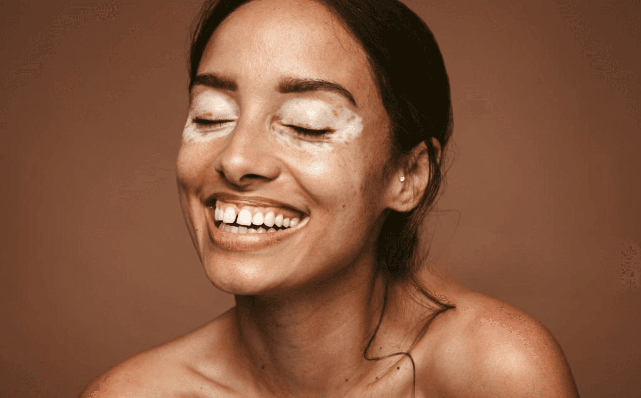 Vitiligo